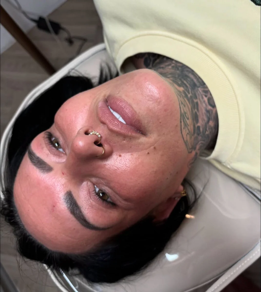 Close-up of a lower face result after aesthetic treatment