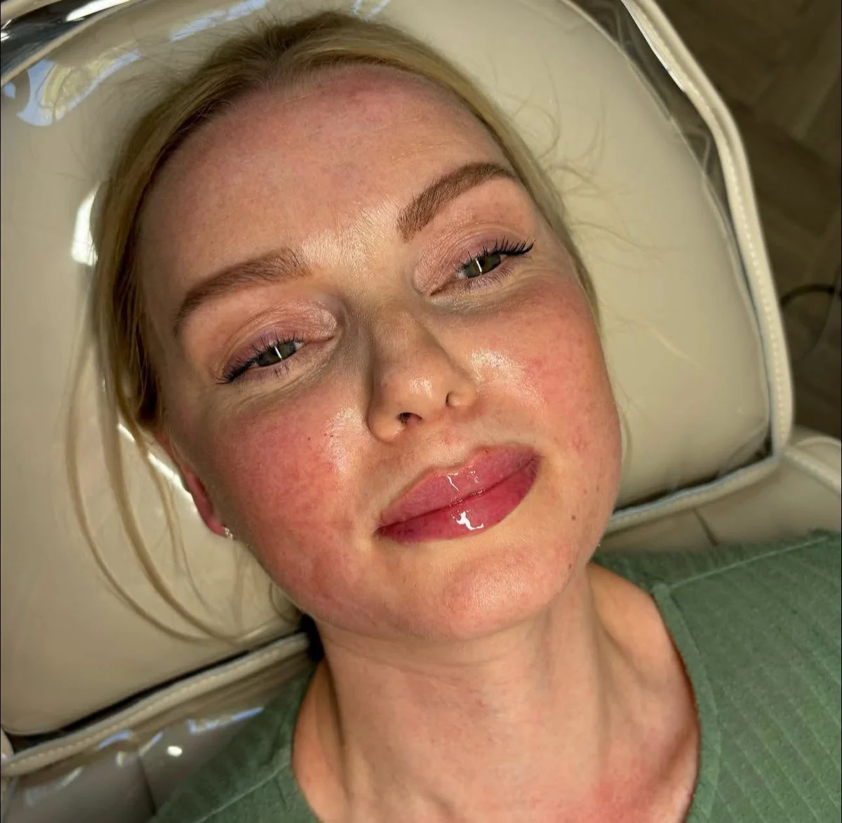Freshly treated lip filler result, front view