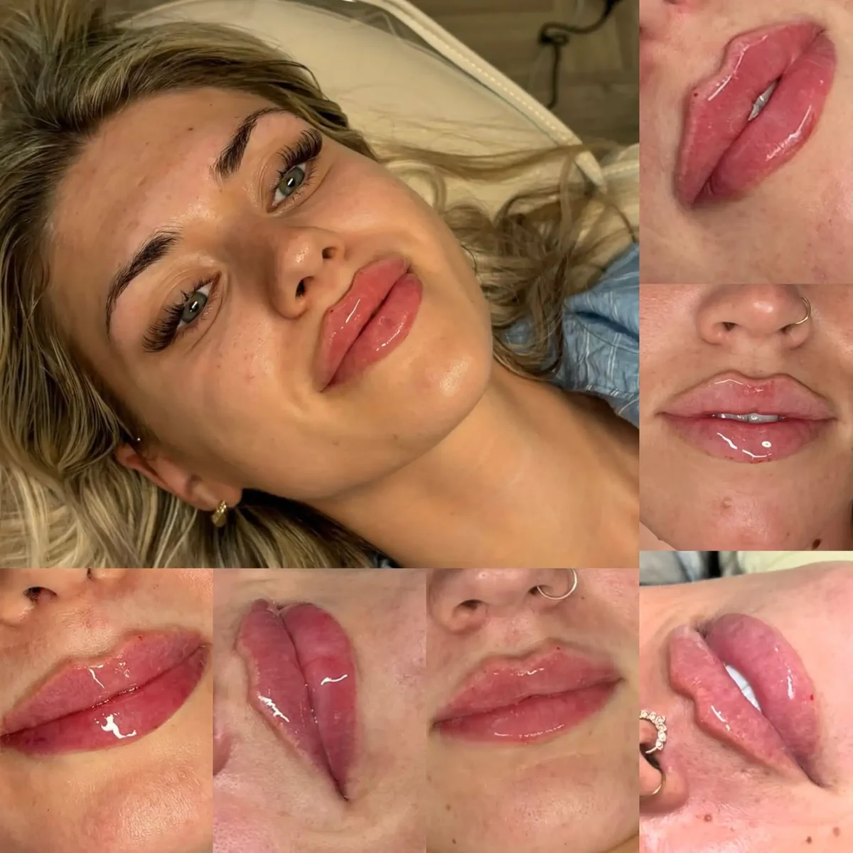 Lip filler results photographed from several angles