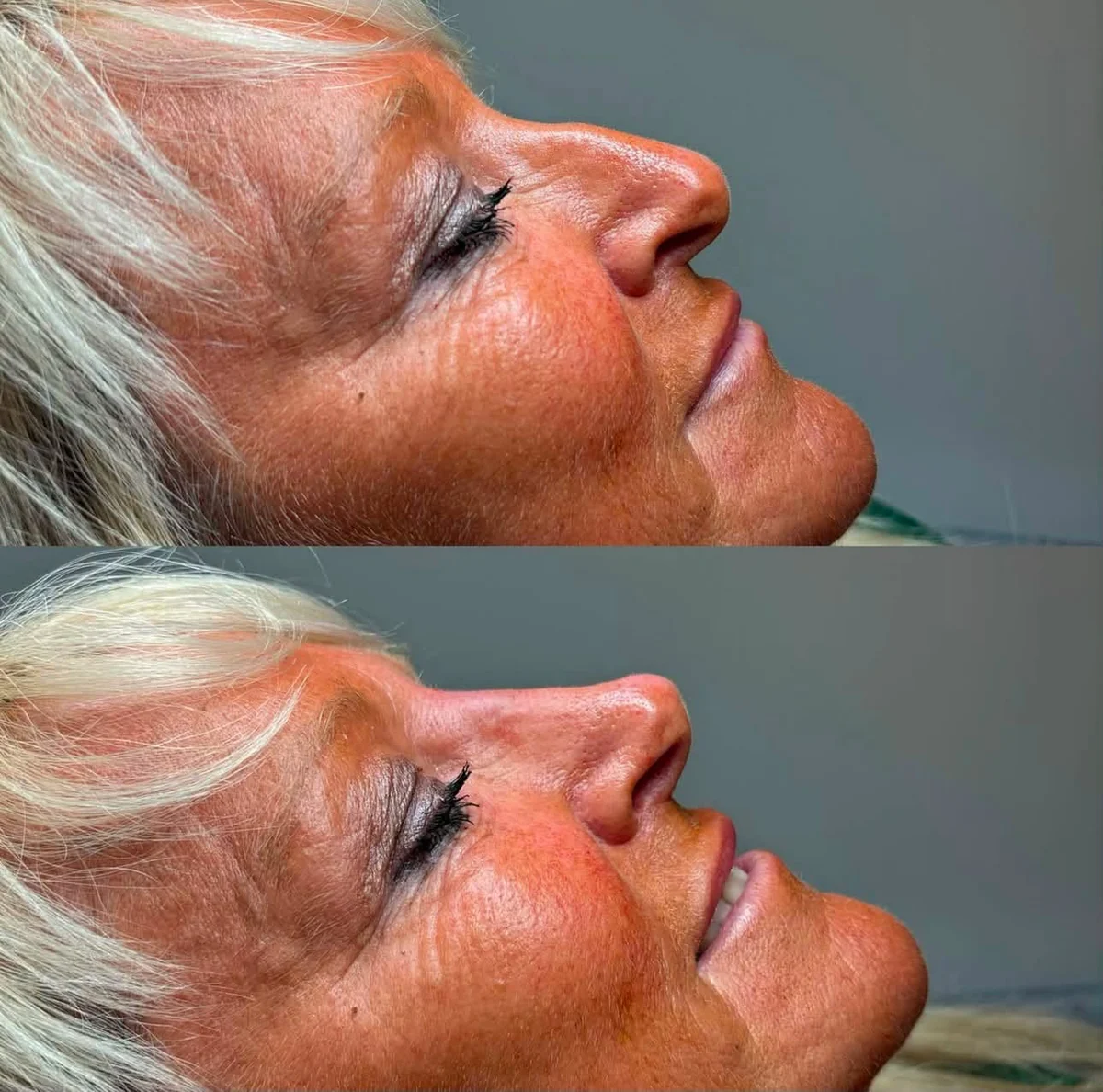 Before and after non-surgical profile refinement, side view