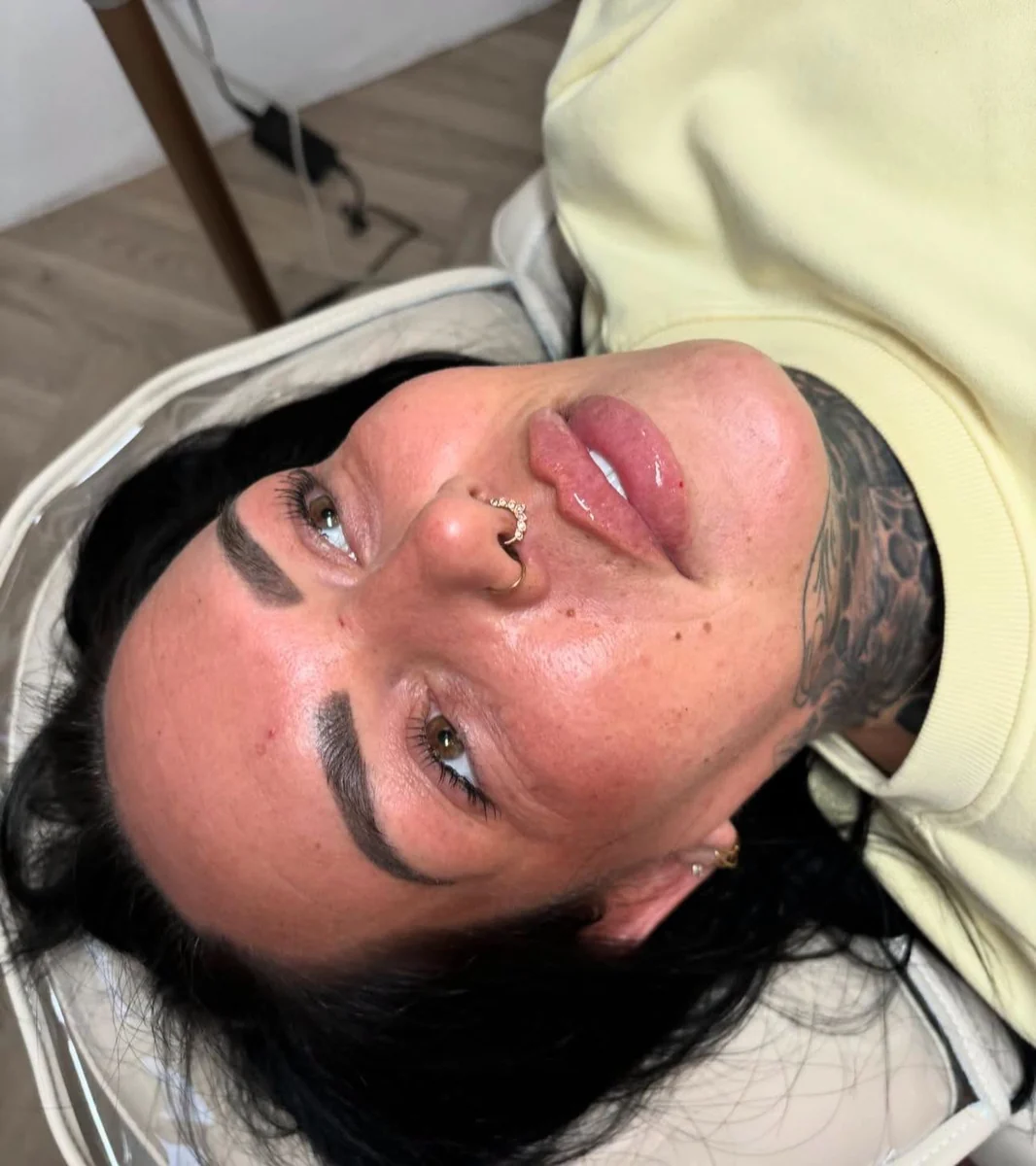 Close-up of a soft, balanced lip filler result